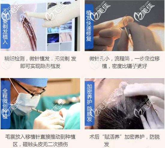 廣州華美先進的毛發(fā)移植技術(shù) 廣州華美先進的毛發(fā)移植技術(shù)