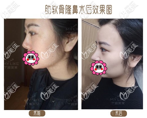 肋軟骨隆鼻術(shù)后對(duì)比效果圖一