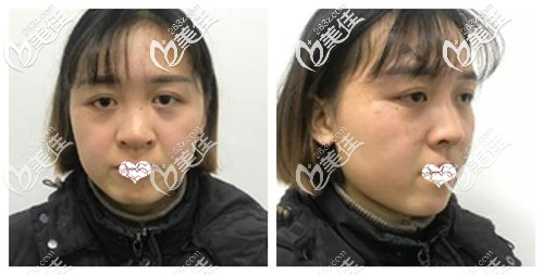 都說(shuō)鼻綜合局麻生不如死 可是我做肋骨鼻術(shù)中和術(shù)后都沒(méi)有太大痛感