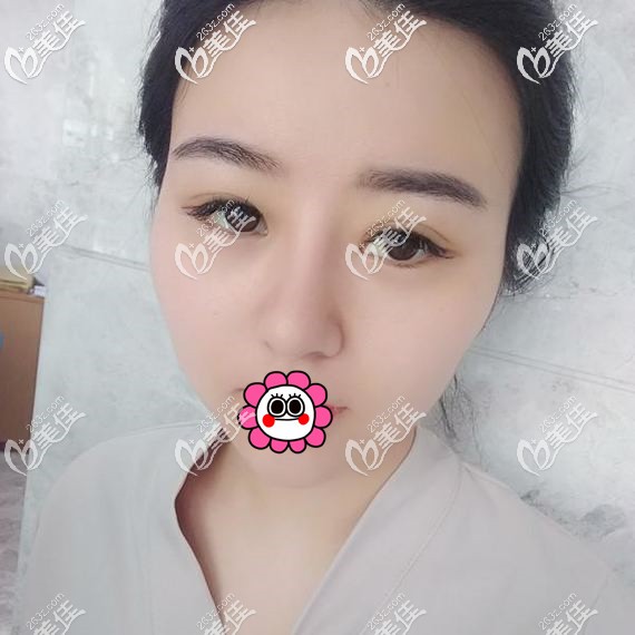 肋軟骨隆鼻修復難度比較大，沒想到找寧波美萊孫明磊竟然成功了