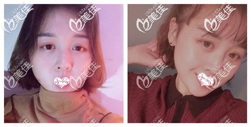 綜合鼻整形術(shù)后3個(gè)月恢復(fù)自然 綜合鼻整形術(shù)后3個(gè)月恢復(fù)自然