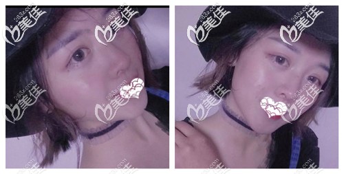 綜合鼻整形術(shù)后2個(gè)月鼻子基本恢復(fù) 綜合鼻整形術(shù)后2個(gè)月鼻子基本恢復(fù)