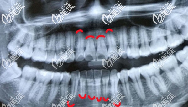 先天性牙根短小全景片示意圖