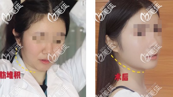 面部黃金微雕后圖片