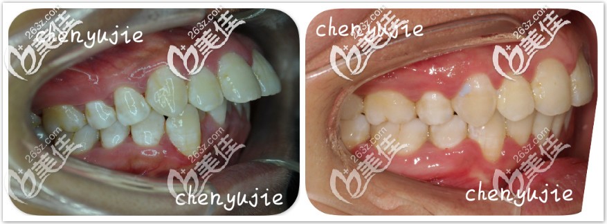 門牙外凸隱形矯正前后對比圖