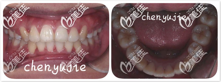 深覆合牙齒前后變化圖