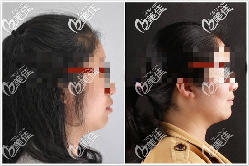 深覆合矯正后臉型也有改善
