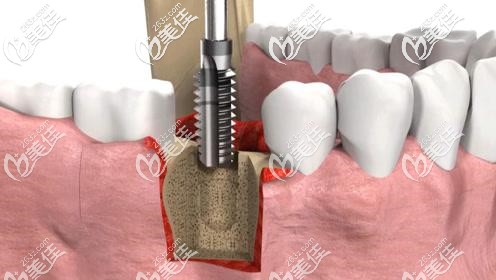 種牙價(jià)格為什么那么貴 種牙價(jià)格為什么那么貴