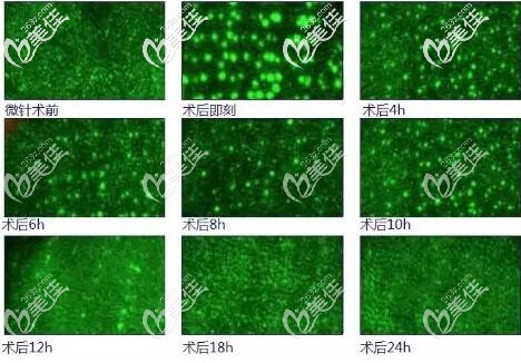 微針治療后的變化情況