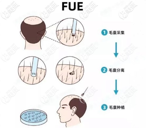 植發(fā)手術(shù)操作過程原理 植發(fā)手術(shù)操作過程原理