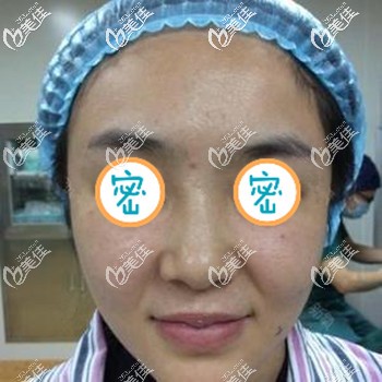 做全臉埋線提升后法令紋得到改善 做全臉埋線提升后法令紋得到改善