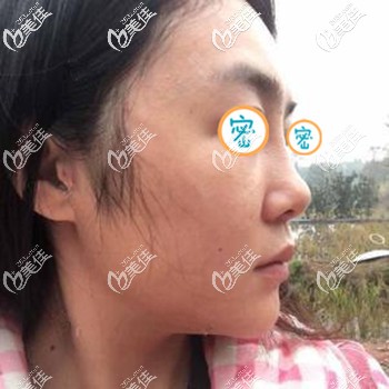 面部埋線提升的傷口不明顯 面部埋線提升的傷口不明顯