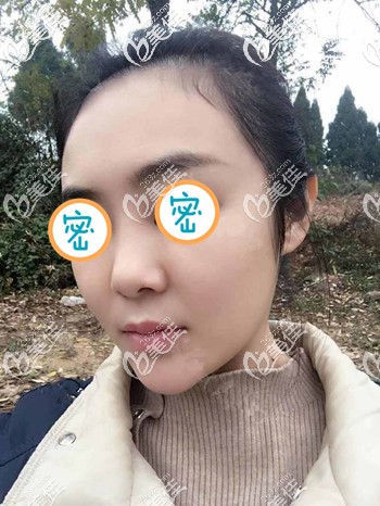 雖然不知道我法令紋埋線用了幾根,但從全臉提升效果來看效果還是不錯(cuò)的