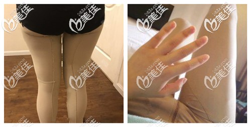 剛做完吸脂術(shù)后大腿腫脹 剛做完吸脂術(shù)后大腿腫脹