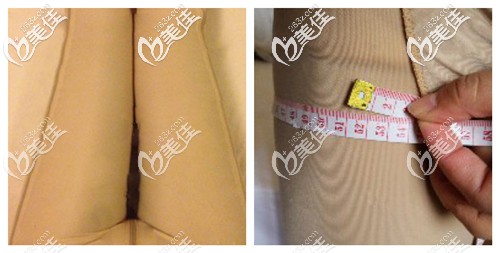 吸脂瘦大腿手術(shù)后穿塑腿褲有助于腿部線條塑造 吸脂瘦大腿手術(shù)后穿塑腿褲有助于腿部線條塑造