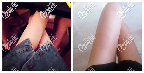 吸脂瘦大腿術(shù)后3個(gè)月腿圍變小 吸脂瘦大腿術(shù)后3個(gè)月腿圍變小