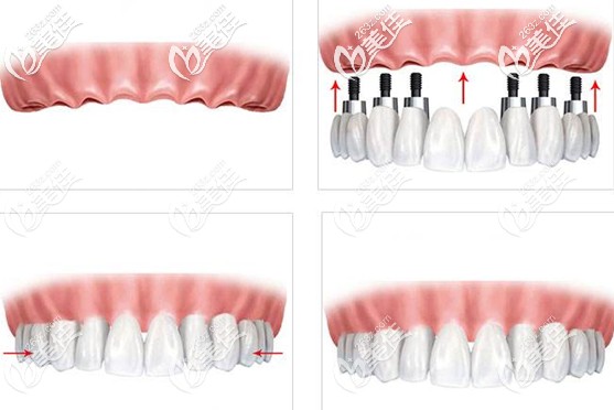 做滿口種植牙的價(jià)格介紹