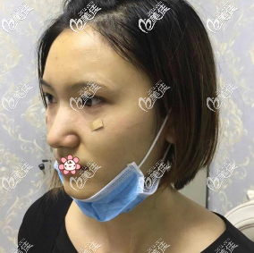 王方鵬祛眼袋術(shù)后3天 王方鵬祛眼袋術(shù)后3天