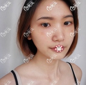 重慶藝星整形祛眼袋怎么樣 重慶藝星整形祛眼袋怎么樣