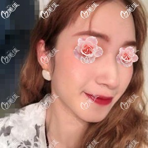 用我在長(zhǎng)沙梵童做熱瑪吉全面部900發(fā)的親身經(jīng)歷來(lái)說(shuō)下到底痛不痛！