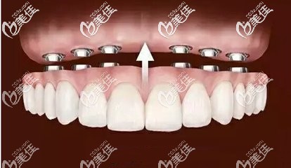 口腔王懷元做種植牙怎么樣