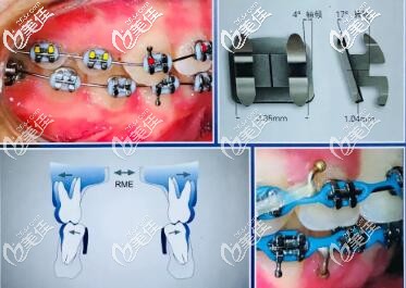 MBT直絲弓正畸技術(shù)