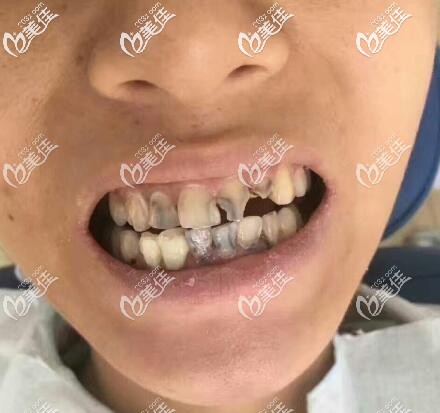 寧波恩吉口腔全瓷牙真人案例