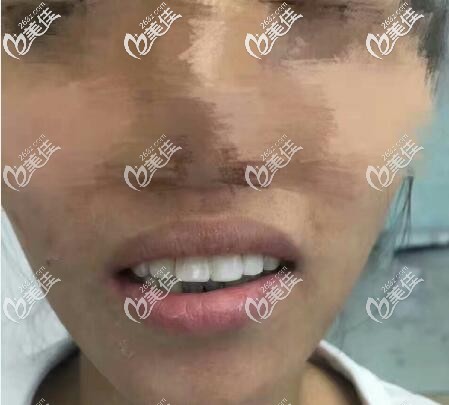 寧波小伙齲齒根管治療后戴了5顆威蘭德全瓷牙啥概念,價(jià)格便宜的烤瓷牙不推薦