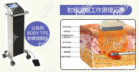 黃金微雕射頻溶脂工作原理示意圖