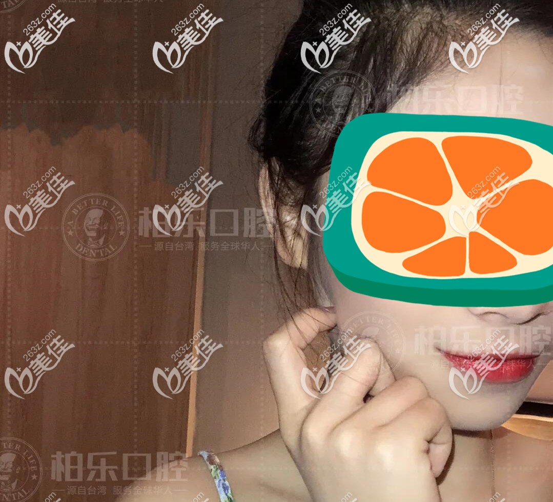 曬下偶在南寧市私立口腔做的虎牙不拔牙矯正前后臉型效果圖,覺得這家口腔收費(fèi)還算正規(guī)