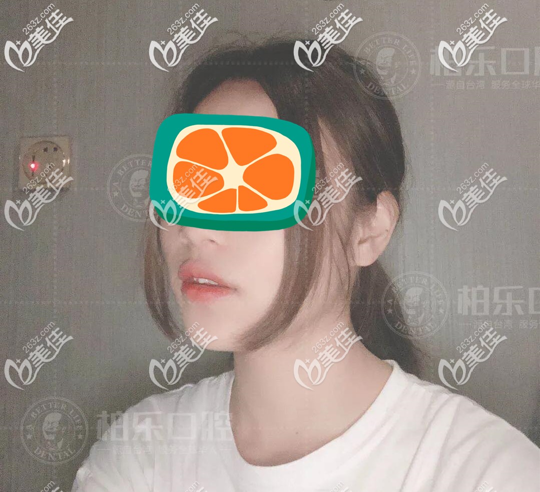 虎牙矯正前圖示 虎牙矯正前圖示