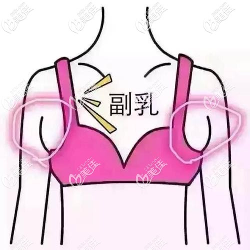 副乳的位置