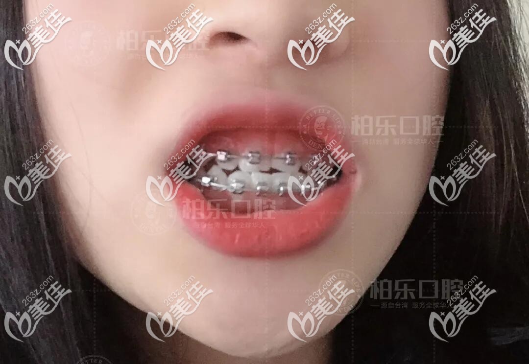 國產(chǎn)自鎖托槽矯正 國產(chǎn)自鎖托槽矯正