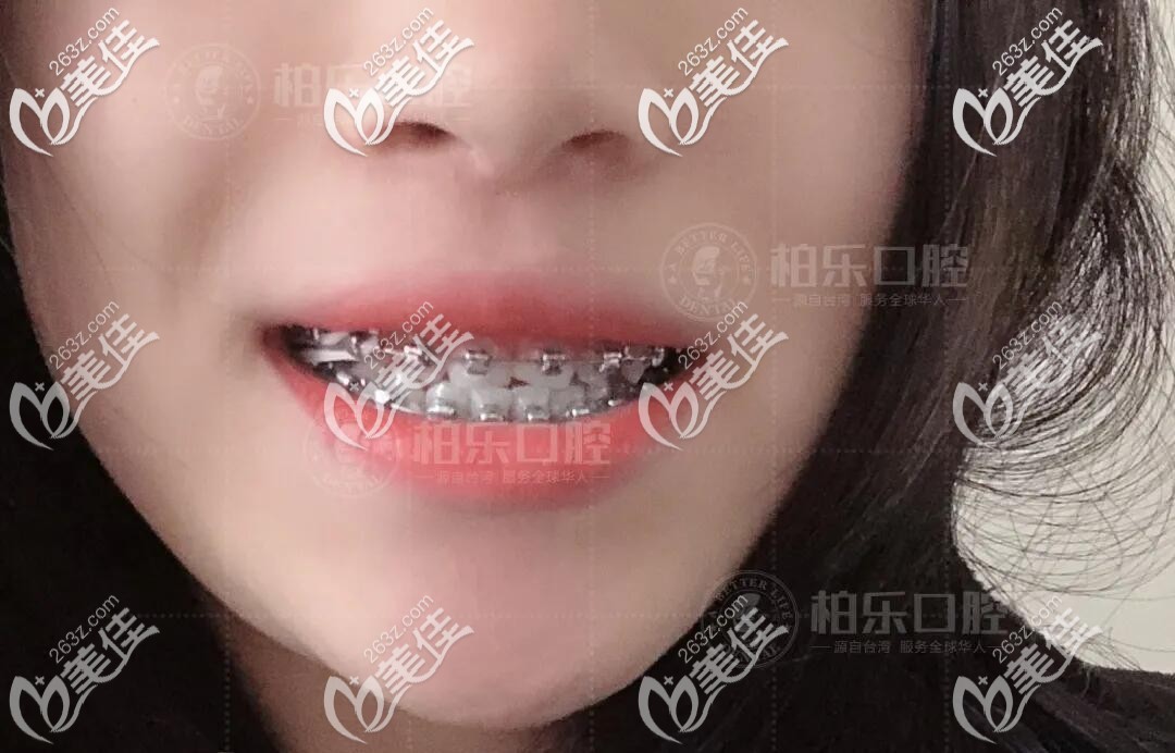 虎牙矯正中效果圖 虎牙矯正中效果圖