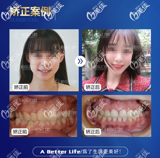 陳世隱醫(yī)生矯正案例 陳世隱醫(yī)生矯正案例