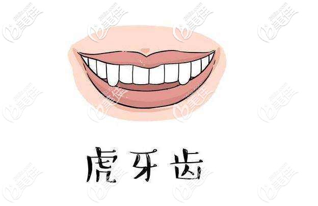 虎牙矯正過程 虎牙矯正過程