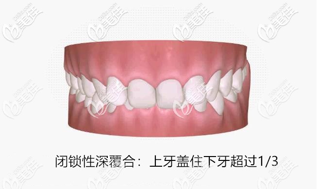 閉鎖性深覆合：上牙蓋住下牙超過1/3