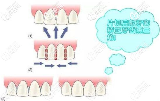 牙齒片切正畸后悔死了？