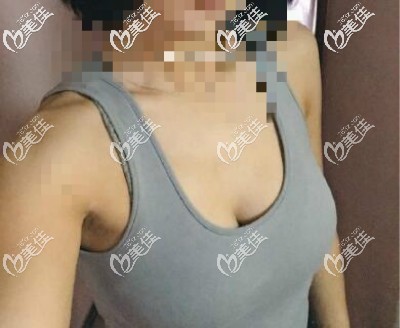 曼托水滴225cc假體隆胸術(shù)后25天<span style= 曼托水滴225cc假體隆胸術(shù)后25天<span style=