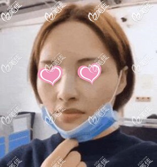 超體隆鼻術(shù)后當(dāng)天照 超體隆鼻術(shù)后當(dāng)天照