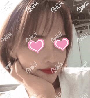 超體隆鼻術(shù)后14天照片 超體隆鼻術(shù)后14天照片