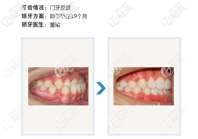 門牙反頜矯正案例 門牙反頜矯正案例