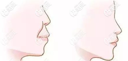 深覆合矯正前后臉型變化 深覆合矯正前后臉型變化