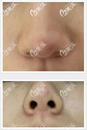 耳軟骨隆鼻后鼻尖凸起的原因