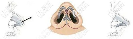 鼻尖張力也會(huì)導(dǎo)致耳軟骨顯形