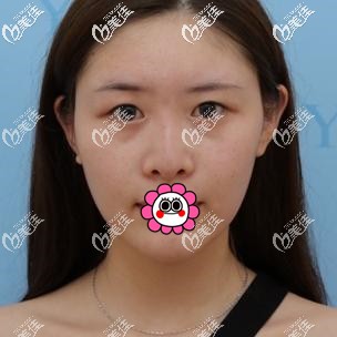 到溫州藝星做眼鼻整形前 到溫州藝星做眼鼻整形前