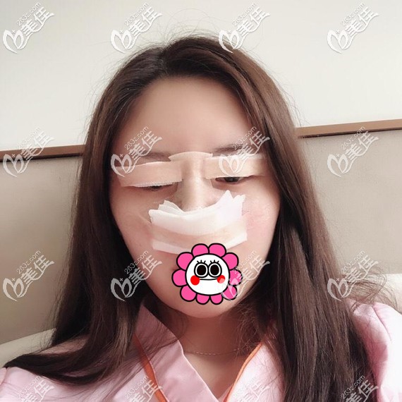 眼鼻整形術(shù)后即刻 眼鼻整形術(shù)后即刻