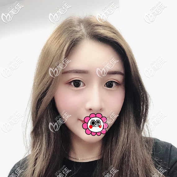 眼睛和鼻子先做哪一個(gè)好呢？我在溫州藝星找譚立文雙眼皮和肋軟骨隆鼻一起做變化更美