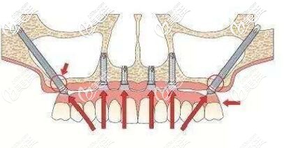 穿顴種植牙圖片