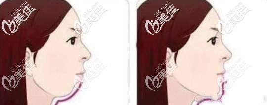 側(cè)臉沒有下頜線怎么辦 側(cè)臉沒有下頜線怎么辦